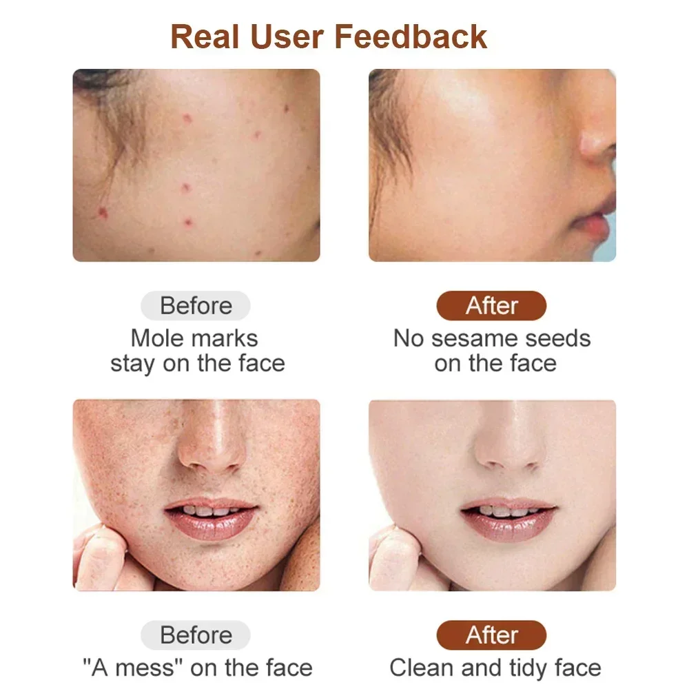 Skin Tag Remover Electric Skin Tags Removal Dark Spot Mole Remover Pen Freckle Wart Tattoo Nevus Black Spots Laser Plasma Pen