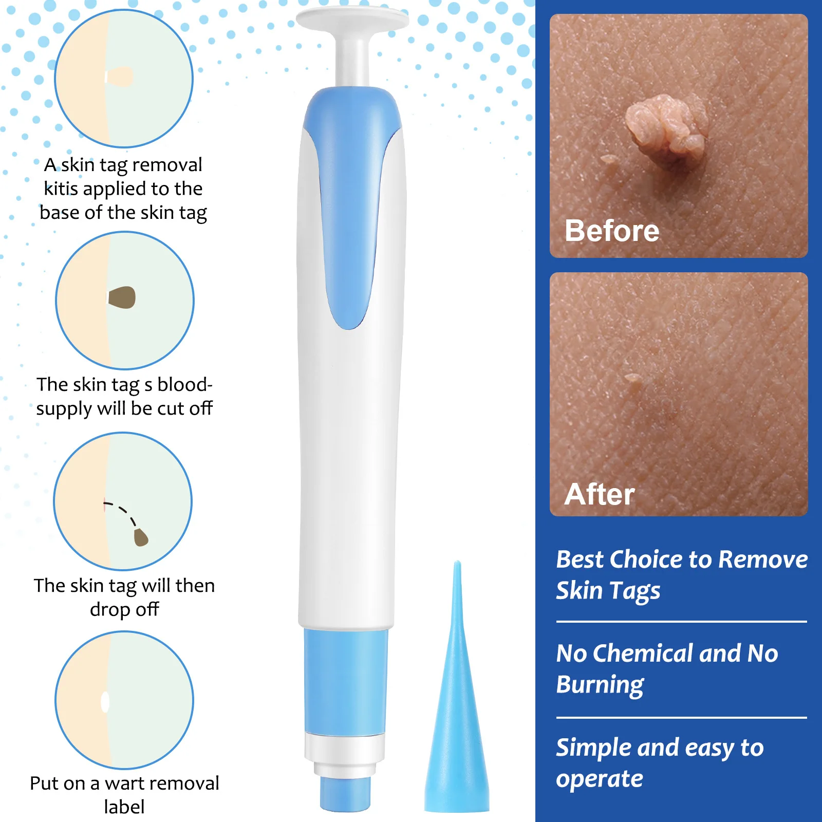 Painless Mole Removal Tool Kit for Facial Skin Care