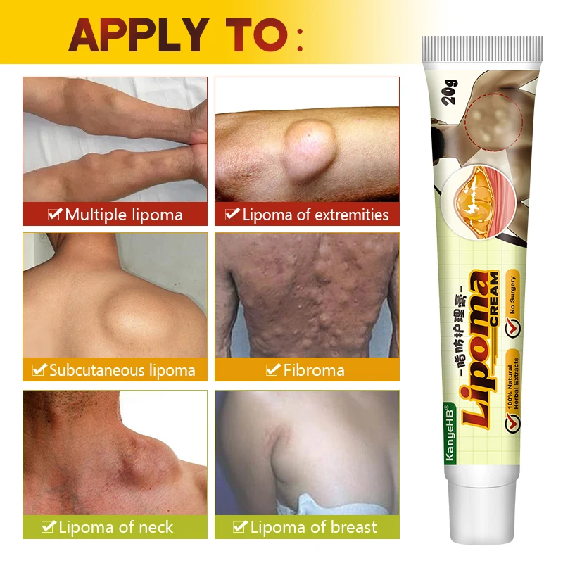 Pain relief cream,skin care ointment 1Pcs Lipoma Removal Cream Relief Pain Skin Swelling Lipolysis Cellulite Fat Lump Nodule Removal Ointment Anti-tumor Plaster G040