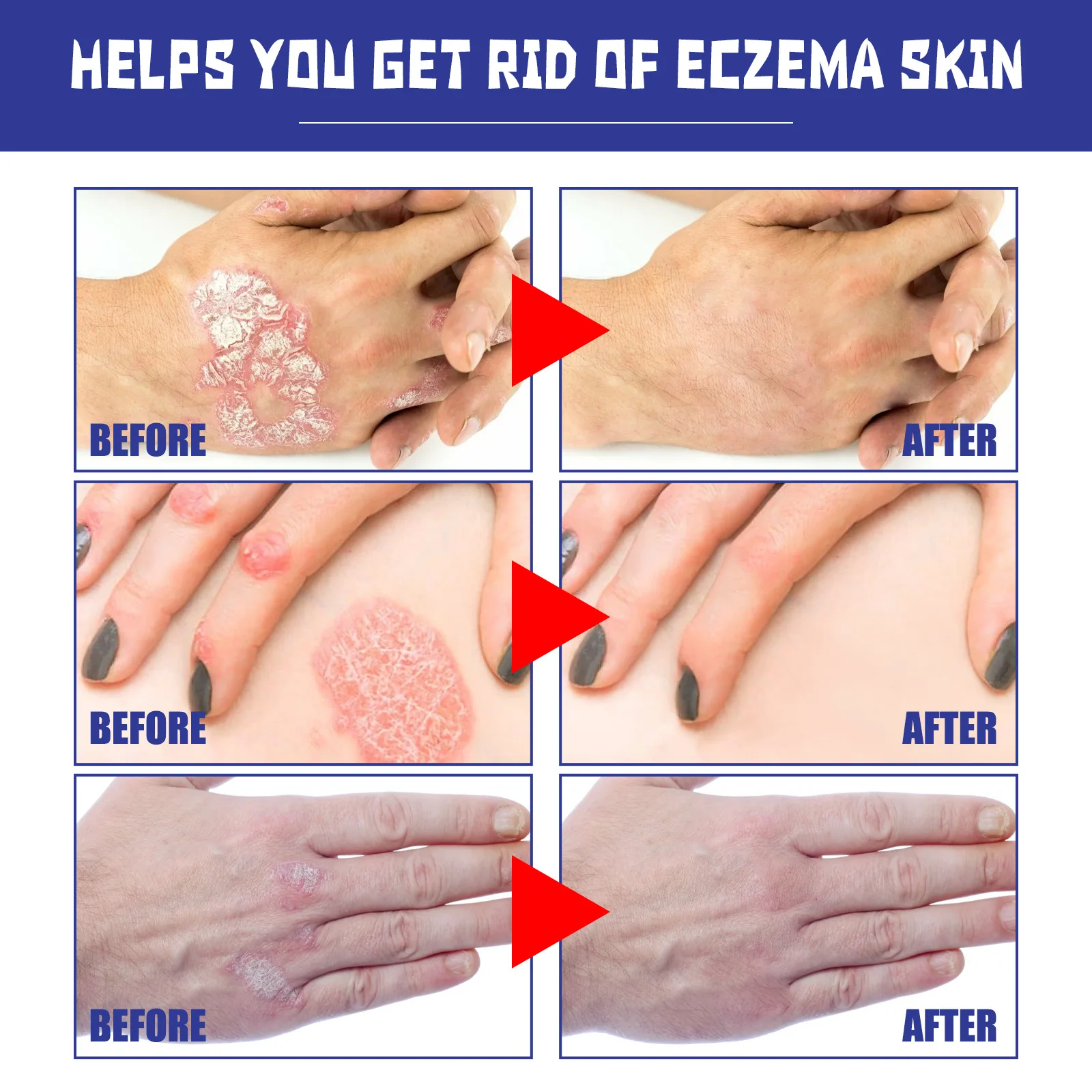 Рисунок 6 - Антибактериальный спрей от псориаза