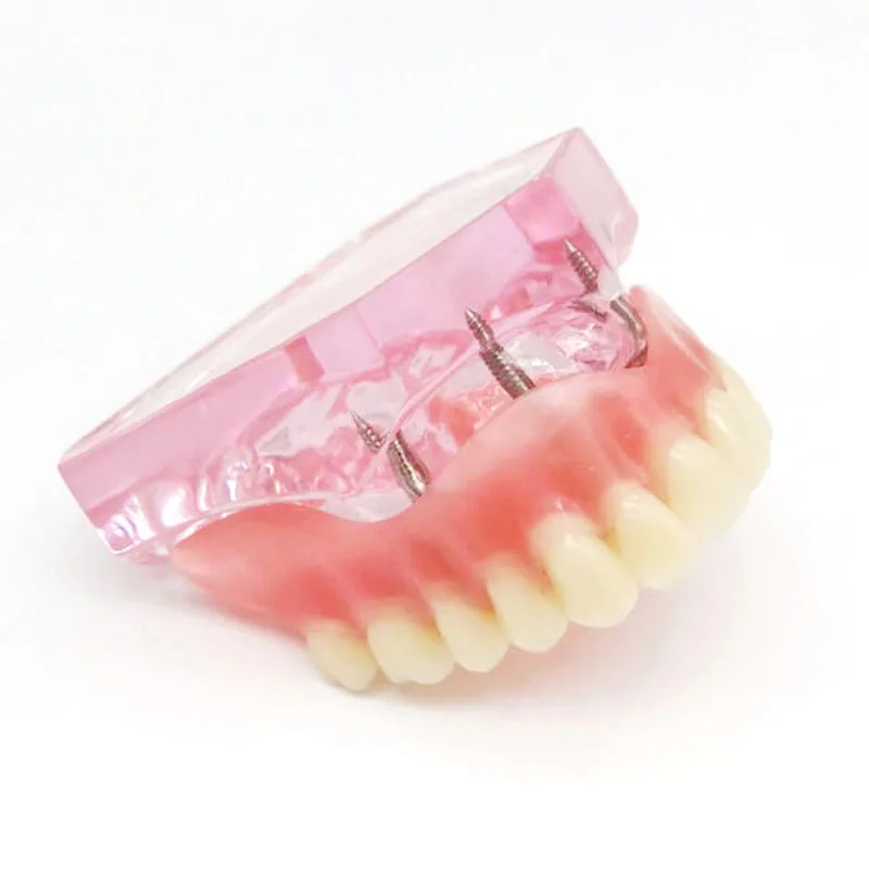 Стоматологический-зубной-протез-имплантат-и-реставрационная-модель-верхней-половины-рта