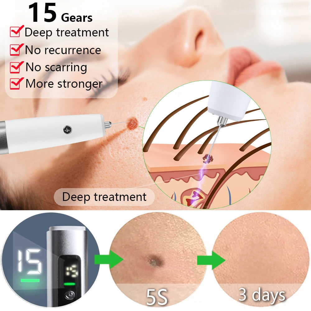 Laser Plasma Pen Electric Mole Remover Black Dots Wart Spot Freckle Dark Dot Nevus Flat Tattoo Skin Tag Removal