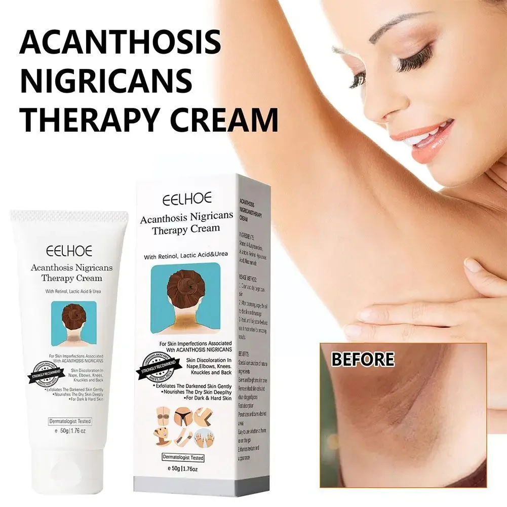 

Sdottor New EELHOE Acanthosis Nigricans Лечебный крем для подмышек коленных суставов черный увлажняющий и отбеливающий тело Ca