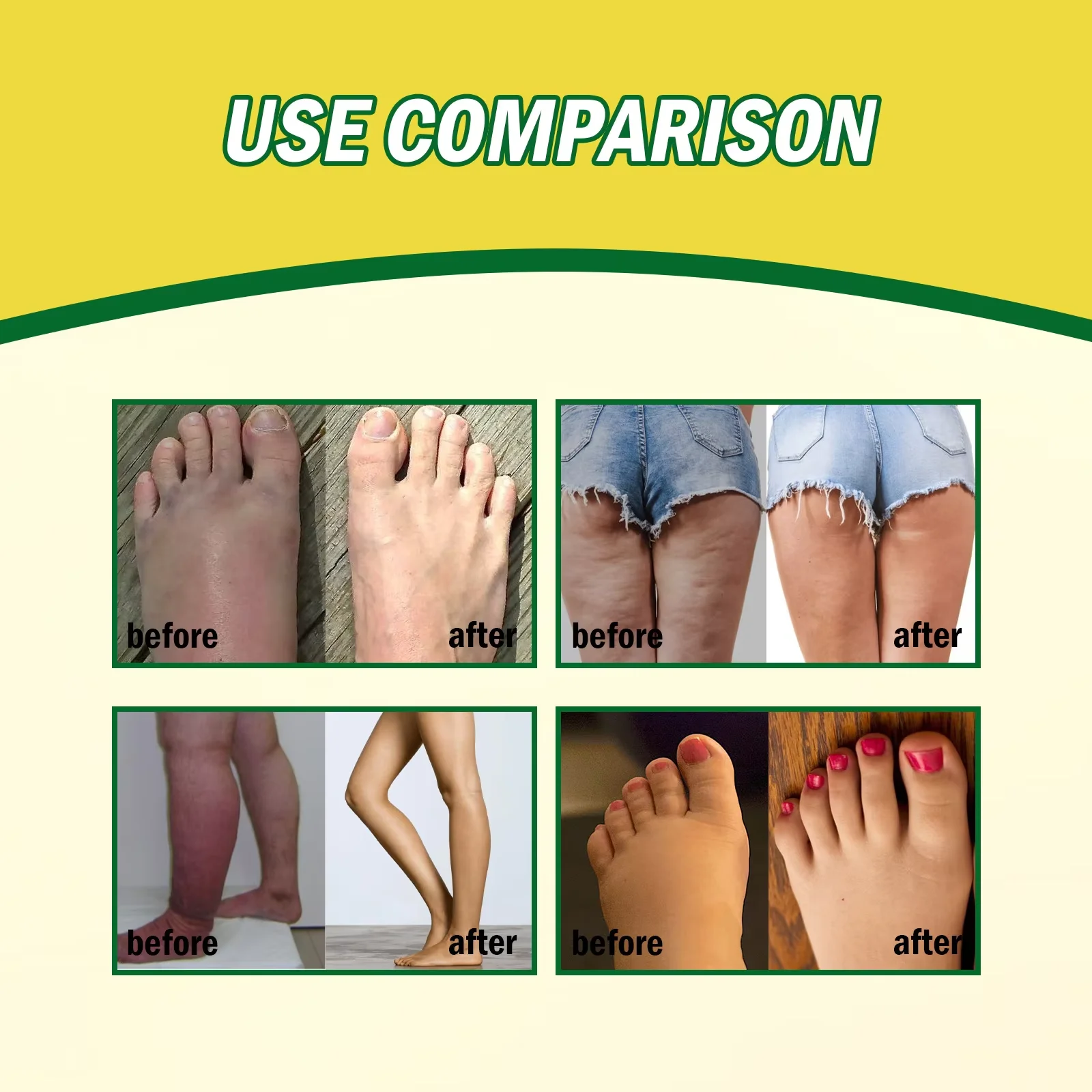Leg Swelling Relief Cream Joint Soreness Pain Therapy Legs Edema Treatment Slimming Detoxifying Dehumidification Care Product
