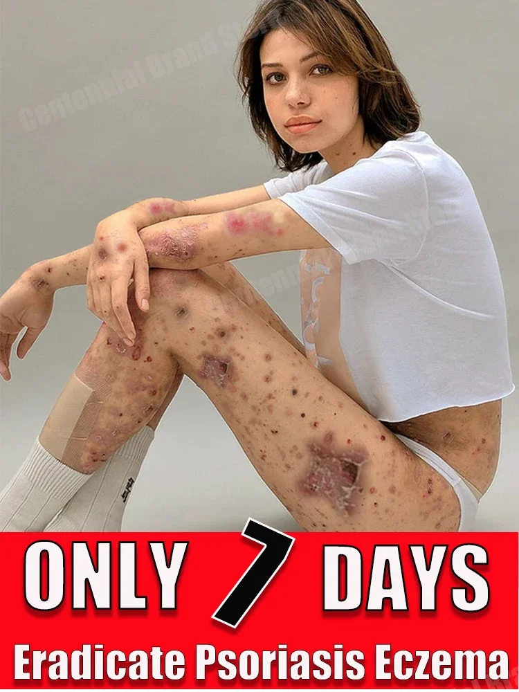 

Psoriasis Treatment Cream Eczema Itchy Cream Anti-Itch Antibacterial Skin Care Products