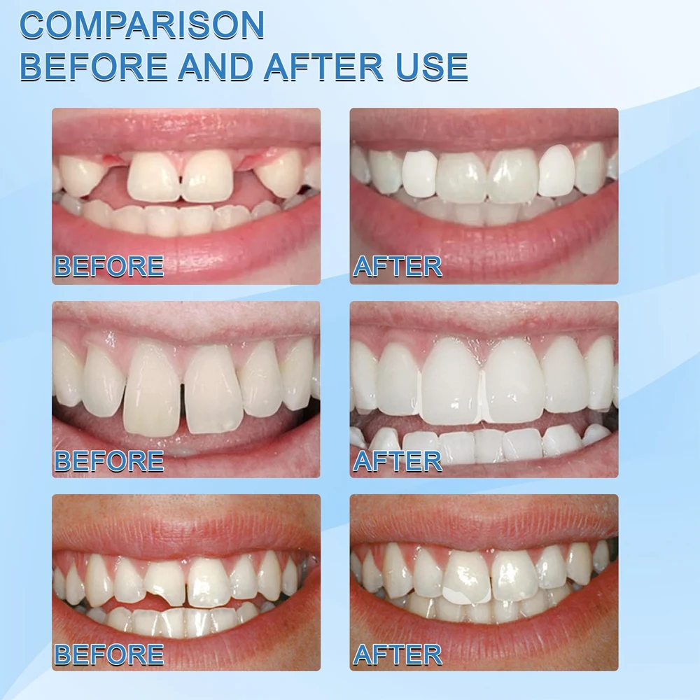 Pegamento para dentadura postiza temporal, pegamento sólido de 50G, cuentas  adhesivas moldeables, reparación de dientes de chapa, color blanco -  AliExpress