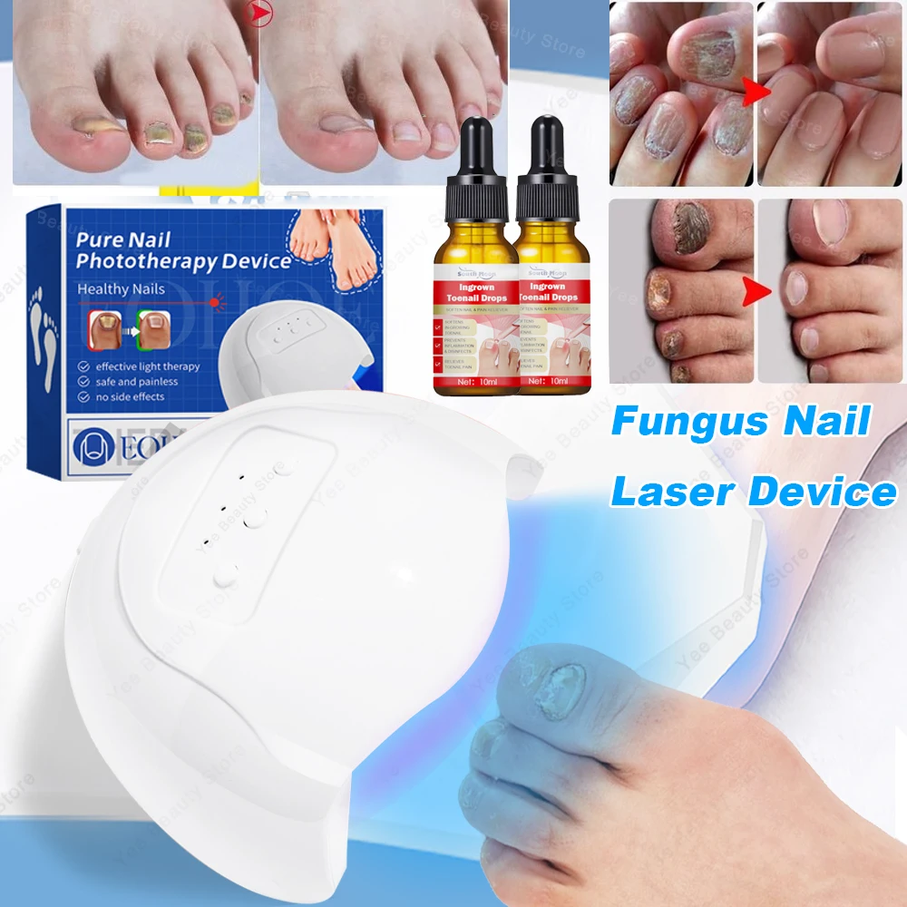 Fungal Nail Laser Treatment Device for Toenail