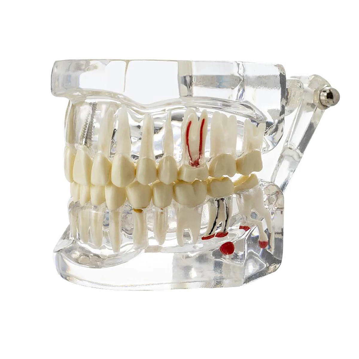 

Disease Teeth Model Dental Implant Tooth Model Dentist For Medical Dental Disease Teaching Study and Patient communication
