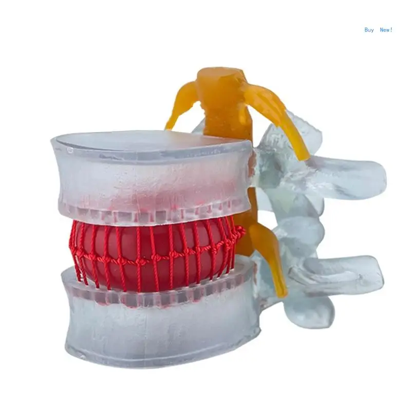 

Anatomy Lumbar Spine Model for Demonstrating Pathological Lumbar Disc Lumbar