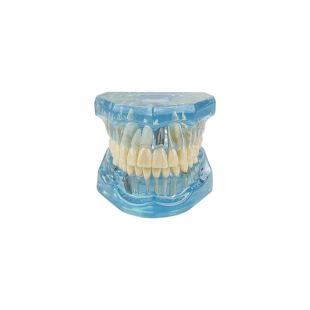 Dental Restoration & Disease Analysis Teaching Model