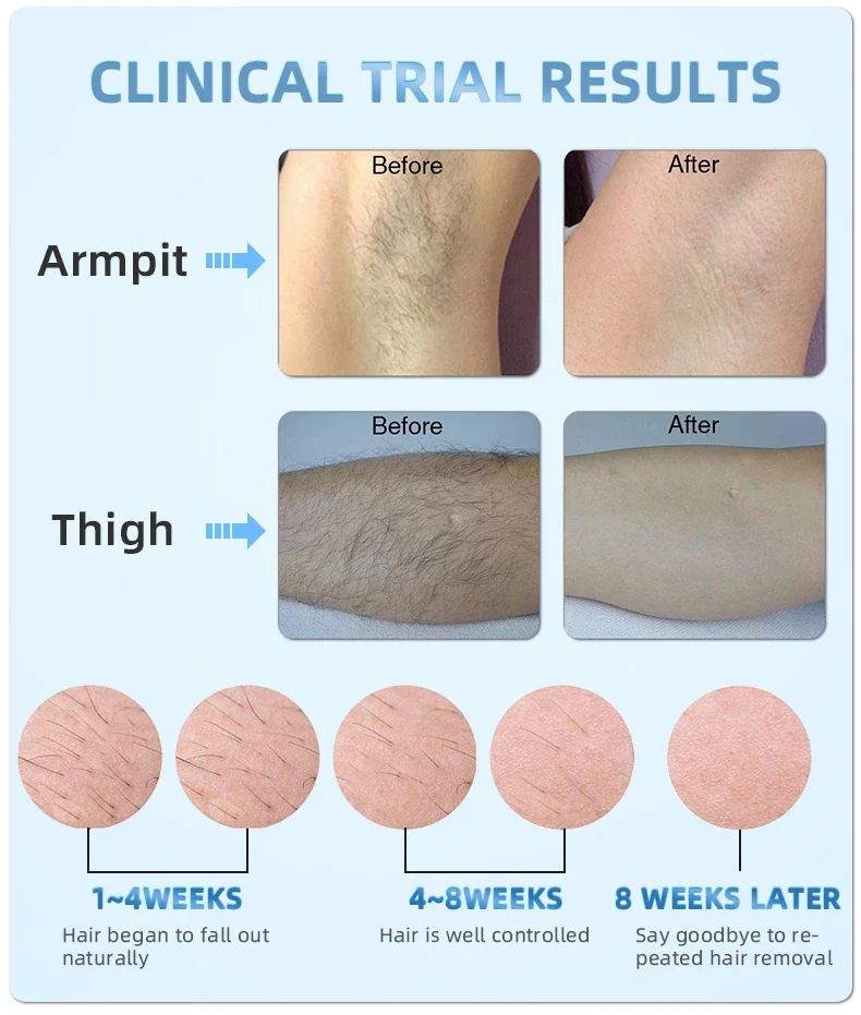 Mlay-IPL جهاز إزالة الشعر بالليزر ، 500000 فلاش ،...