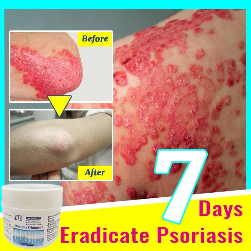 

1/3/5/10pcs Eczema cream used for treating eczema, relieving itching, antifungal infection, psoriasis, and nursing care