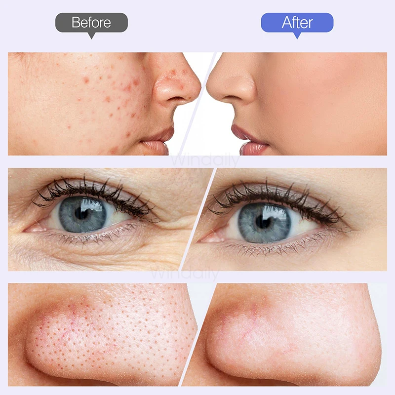 2025 Wireless Diamond Microdermabrasion Machine Blackhead Remover Vacuum Pore Cleaner Facial Skin Care Tool Face Beauty Device