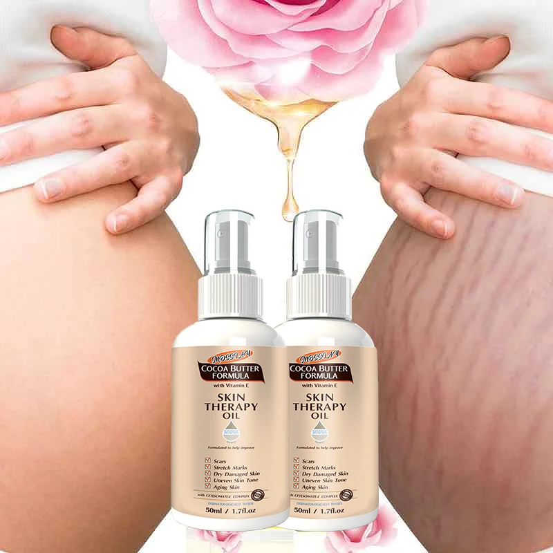 Stretch Mark Spray  Repair  Removal Acne Scar Stretch Marks Cream Fat Scar Striae Gravidarum Treatment Streaks Obesity