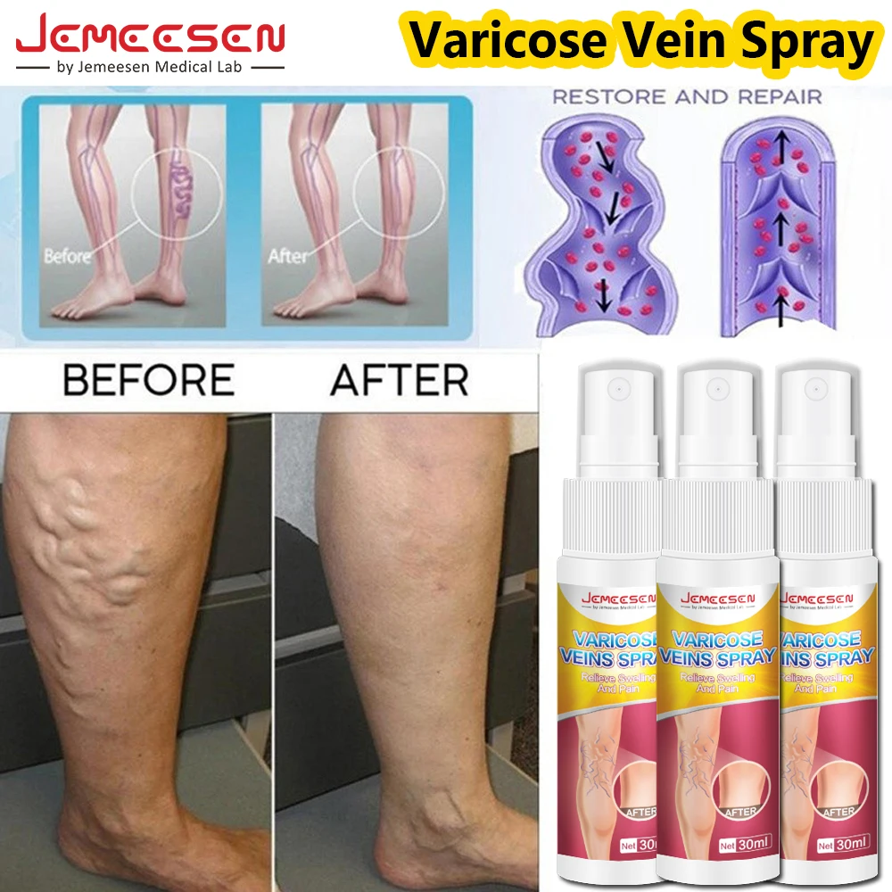 S68627823f0c1479b8dfe005a4906919by Jemeesen Varicose Vein Spray Relieve Legs Dilated Vasculitis Phlebitis Natural Formula Liquid For Varicose Veins Body Care 30ML