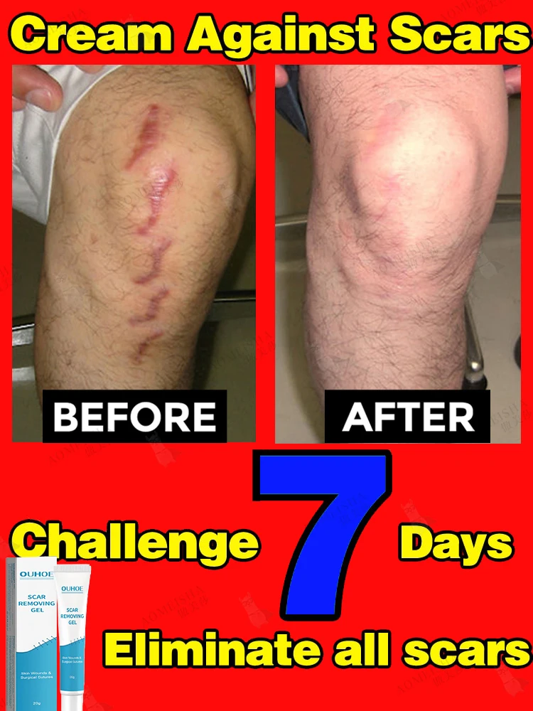 Scarcreamgeleffectiverepairsurgicalscarsstretchmarksacnepits