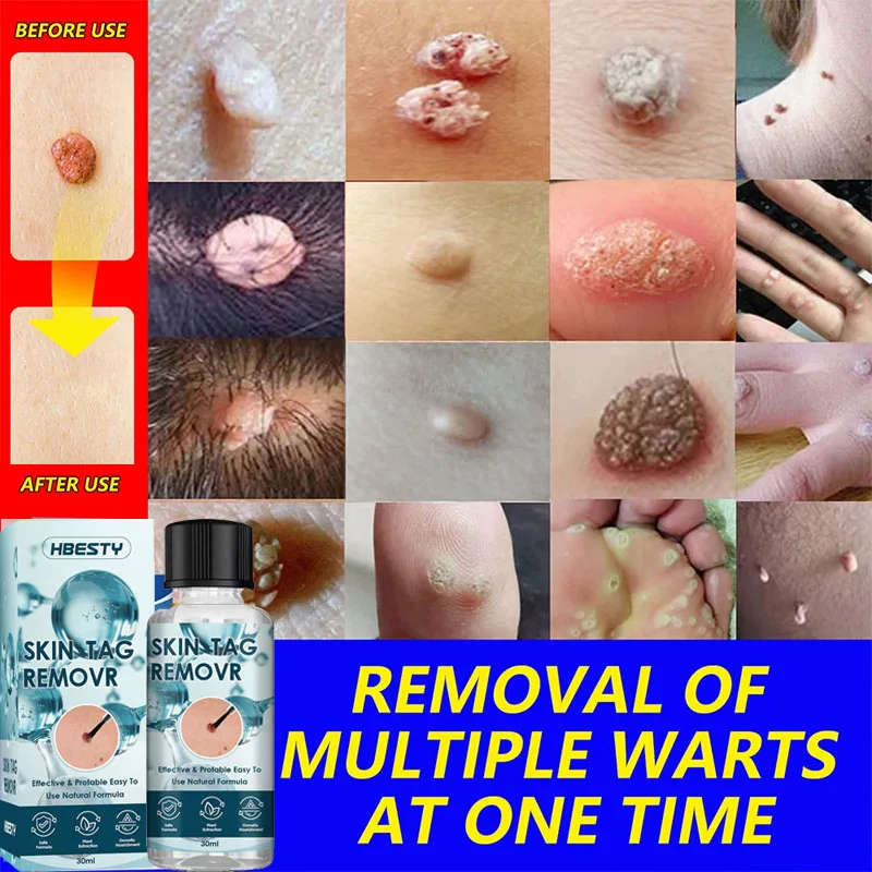 

Wart Removal Essential Oil Remover Skin Tags Treatment Papillomas Body Flat Wart Painless Repair Black Spot Beauty Health Care