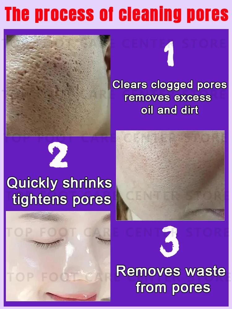 Large pores problem 4