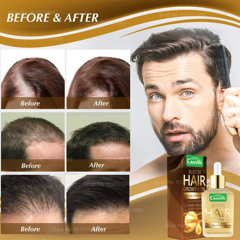 Biotin Hair Regrowth Essential Oil,prevent Hair Loss,natural Growth Serum  For Damaged Hair Treatment Men Women Hair Care Product - Hair Growth  Essential Oils - AliExpress