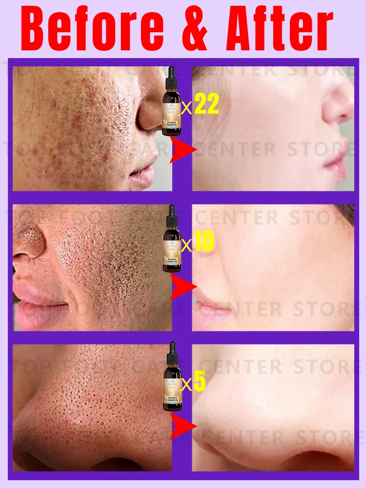 Large pores problem 3