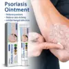 Herbal Psoriasis Treatment Cream Antibacterial Anti-itch Dermatiti Eczema Urticaria Alergy Skin Ointment Beauty Health Body Care