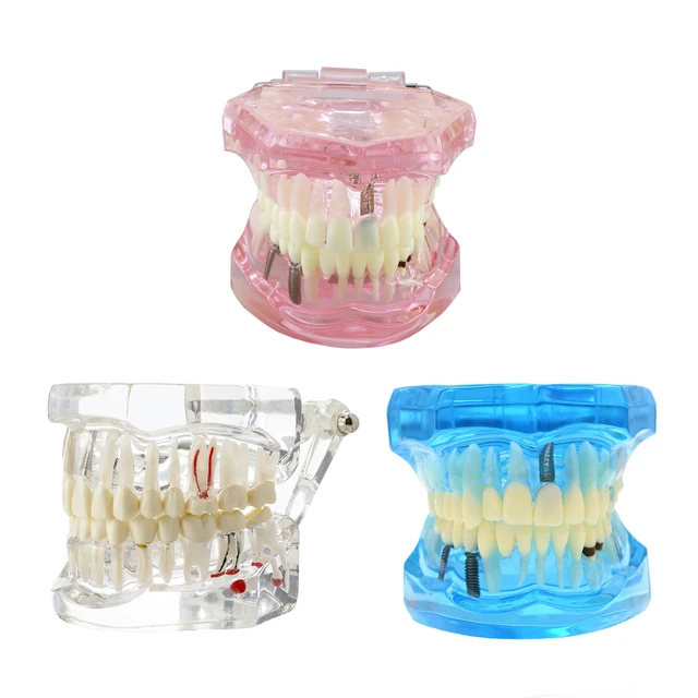 Dental-Typodont-Implant-Teeth-Model-Bridge-Restoration-Pathology-Study-Teach-Demo-Removable-Single-Crown.jpg Dental Typodont Implantat Zähne Modell Brücke Restaurierung Pathologie Studie Teach Demo Abnehmbare Einzelkrone