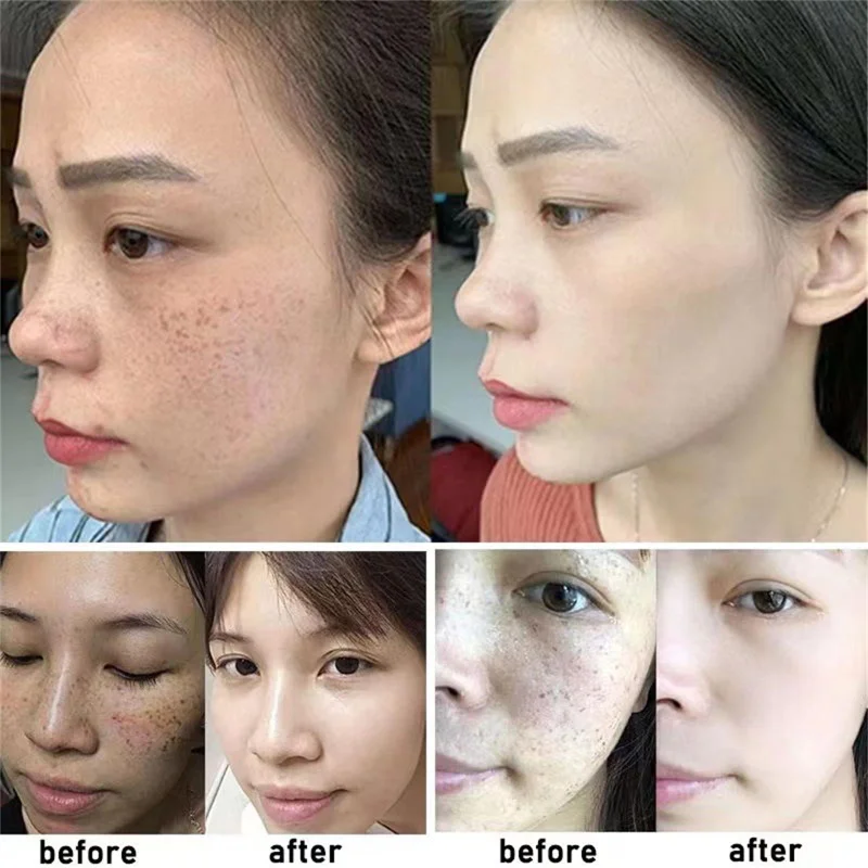 Facial Cream Freckle Whiten Cream Effective Removing Spot Eliminate Brown Stain Melasma Melanin Blemishes Lighten Moisturiser Face Skin Care