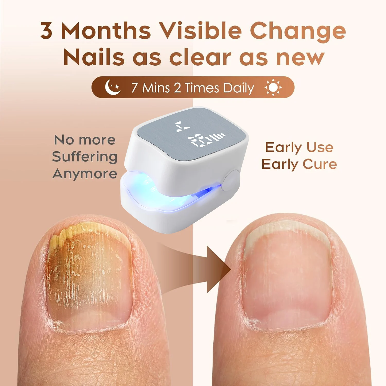 Onychomycosis instrument Portable Nail Fungus Therapy Laser Device Repair Toenail Fingernail