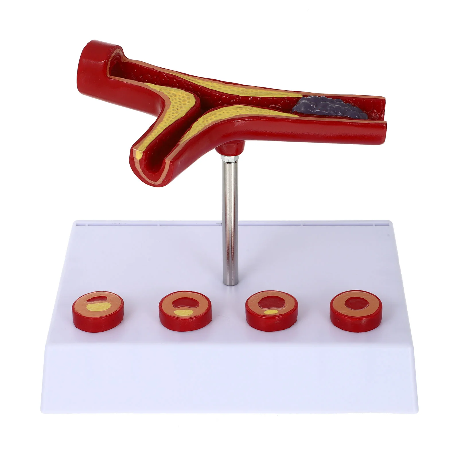 

Model Atherosclerosis Cardiovascular Human Display Blood Vessel Teaching Anatomical Models Medical Tool Vaccumeseal Vascula