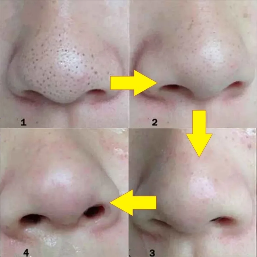 10PCS Nose Blackhead Remover Mask Deep Cleansing Skin Care Shrink Pore Acne Treatment Mask Nose Black Dots Pore Clean Strips 3