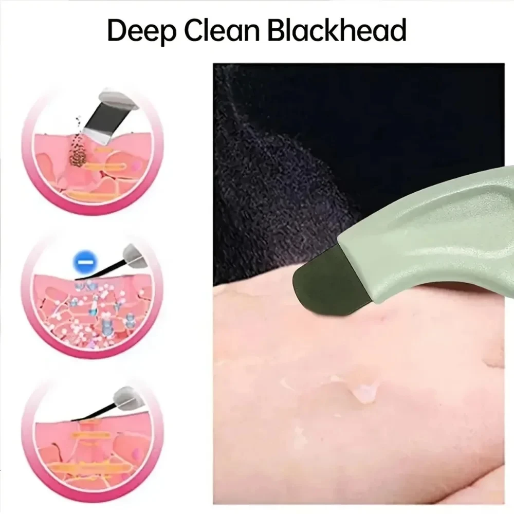 1 raschietto manuale per punti neri, strumento per la bellezza del viso per rimuovere acne e pelle morta - immagine 3