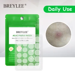 BREYLEE Acne Pimple Patch Acne Treatment Stickers Pimple Remover Tool Blemish Spot Skin Care Face Mask Acne Cream Daily Use