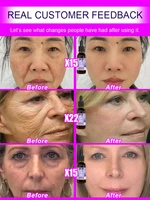 No wrinkles, 20 years younger 3