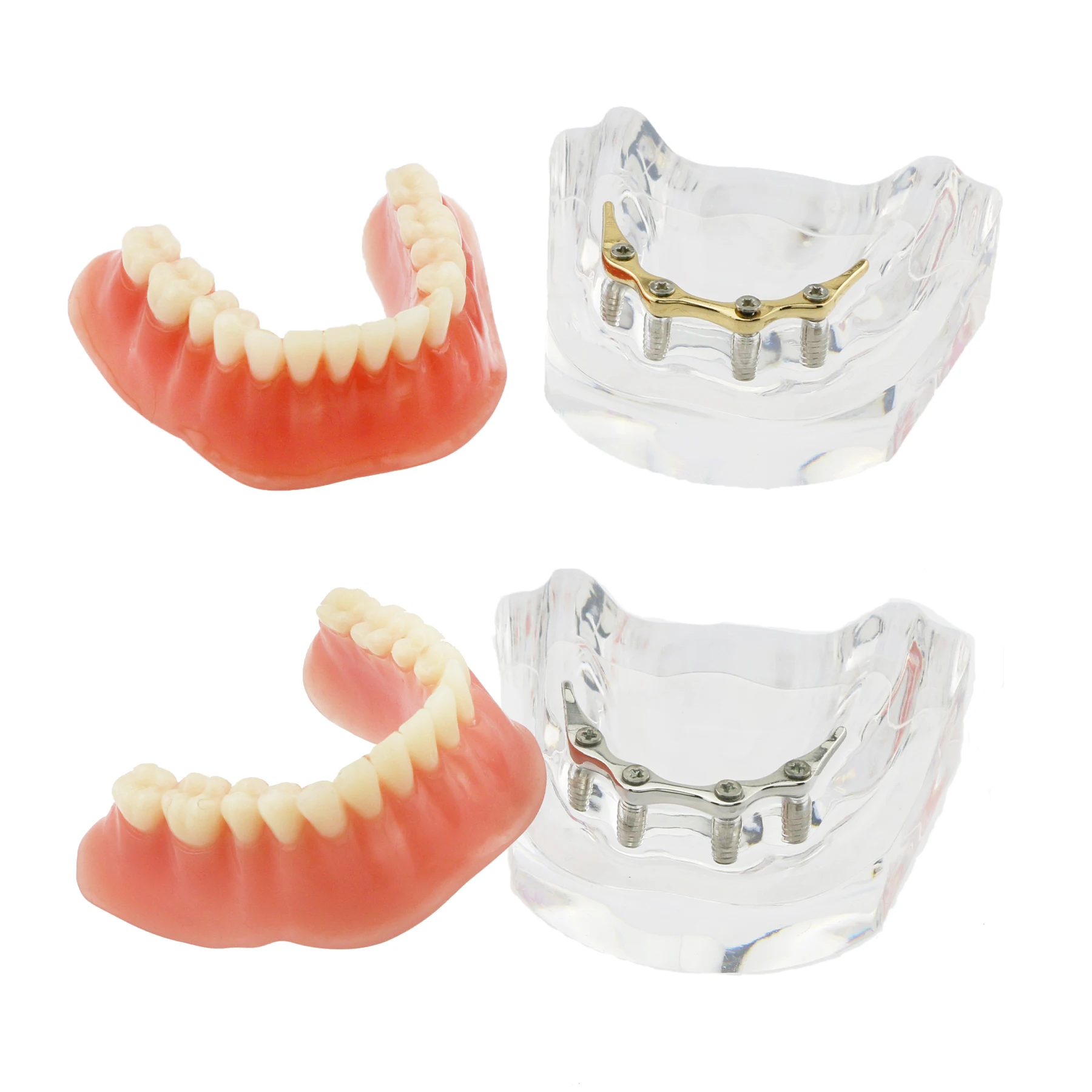 

Dental Implant Teeth Model Removable Overdenture 4 Implants Inferior For Dentist Patient Communication Treatment Study Demo