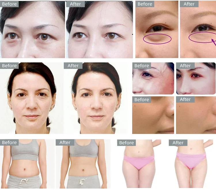 40K ultra-thin ultrasonic liposuction wrinkle removal and facial slimming machine