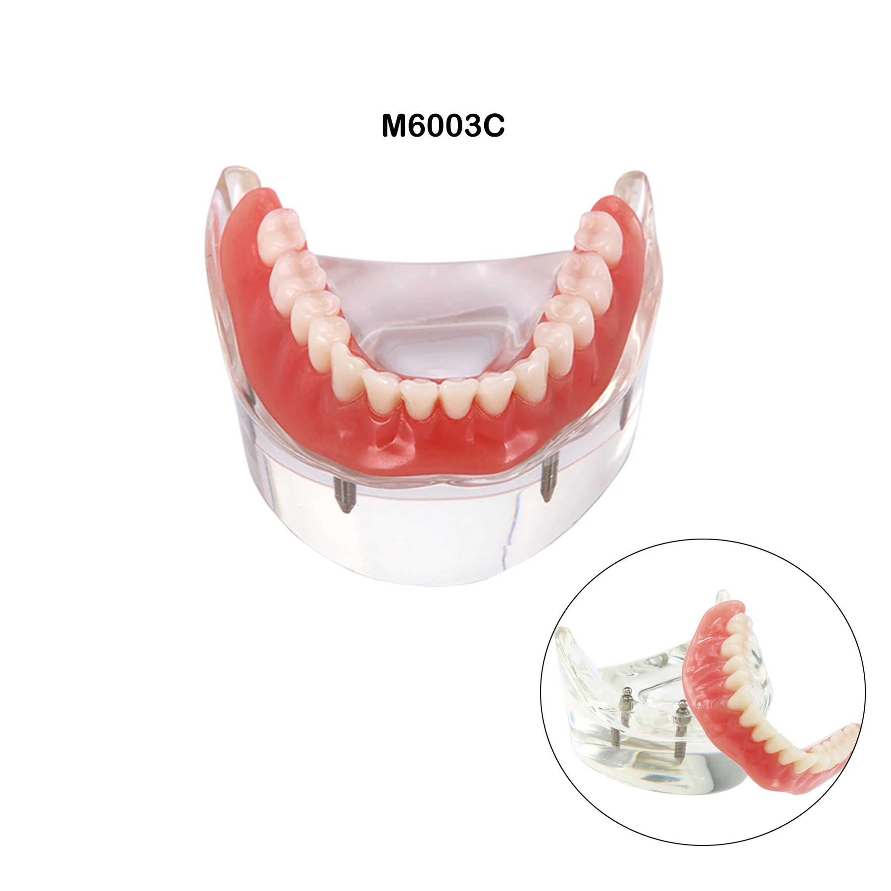 치과용 치아 모형, 임플란트 4개 포함, 오버덴처 복원 모형, 투명 상하악, 치과 의사와 환자 간의 의사소통 시연용
