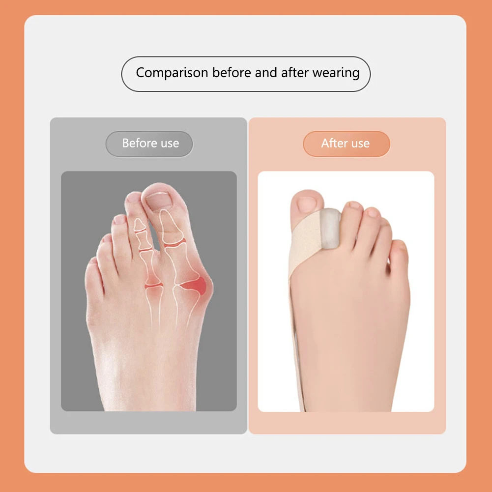 Foot Hallux Valgus Pull Strap Relieve Pain Orthosis