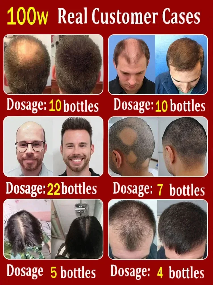 Produtos bem sucedidos,99% dos compradores comprar&atilde;o novamente,eles t&ecirc;m mais e mais cabelo, digamos calv&iacute;cie alfa, cabelo grosso