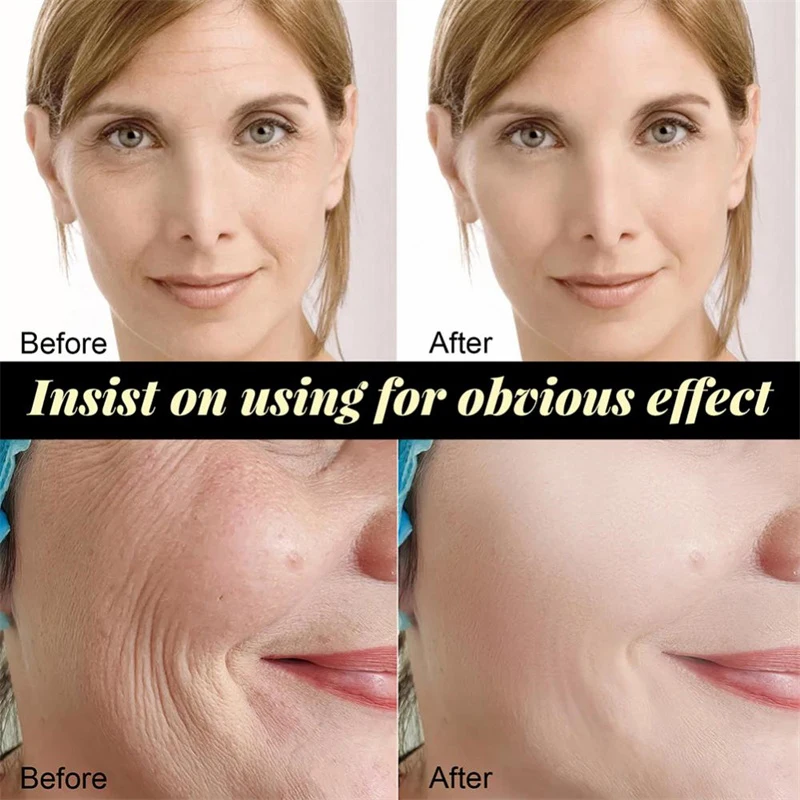 Collagen Protein Thread Instant Wrinkle Remover Serum Set Lifting Firming Soluble Absorbable Face Filler Anti-aging Skin Care 5