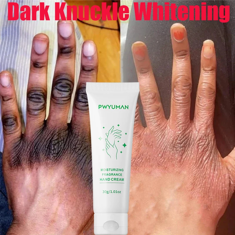 Dark Knuckles Fast Whitening Serum Anti Cracking Cream Pigmentation Correctors For Black Skin Intense Stains Remover Products