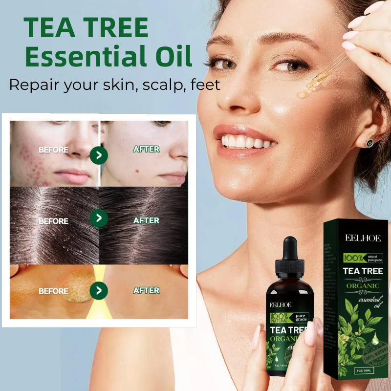 Tea Tree Essential Oil ,Desalting Acne Seal,anti-chapping Foot ,anti-dandruff Body Skin Multi-effect Care Essential Oil