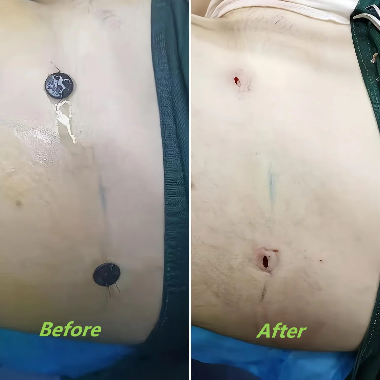 4.5mm Autoclavable Reusable Skin Protectors for Liposuction Surgery Made of Flexible Silicone Multiple Colors 6