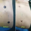 4.5mm Autoclavable Reusable Skin Protectors for Liposuction Surgery Made of Flexible Silicone Multiple Colors 6