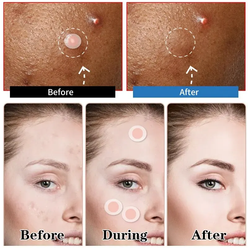 Acne Treatment Patch Repairing Microneedle Spot Blemish Removal Skincare