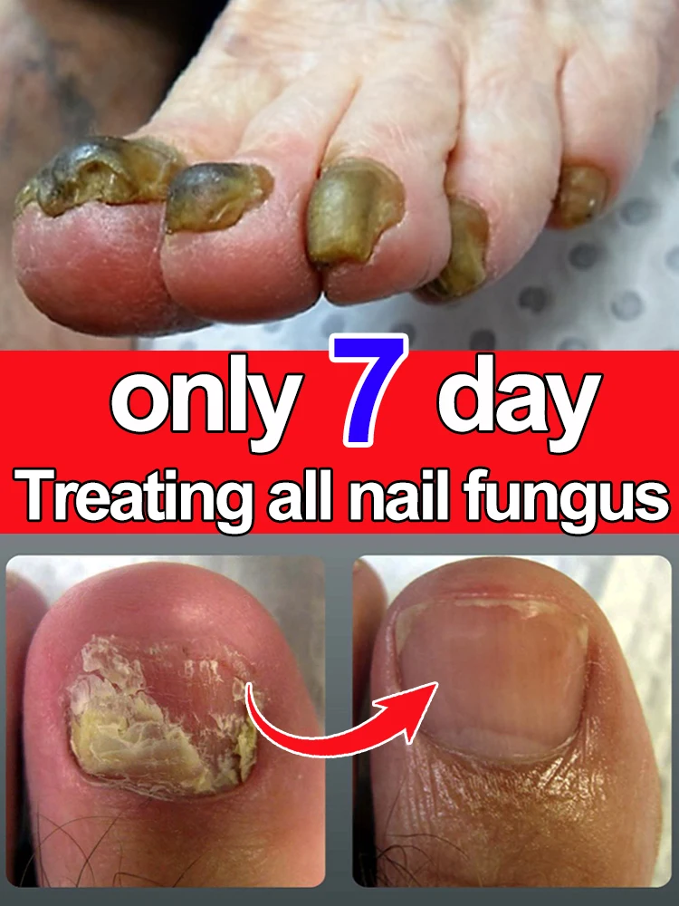 Fungus solution organic essential oil Nail fungus treatment essential oil repair onychomycosis 7 days