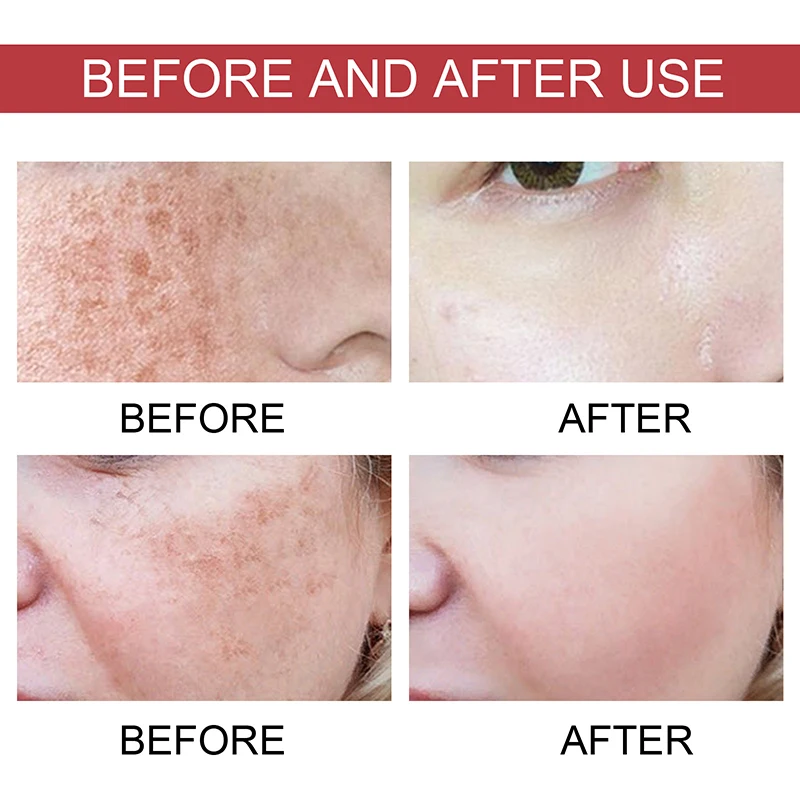 Dark Correcting Essence 10% Niacinamide+ 4% Tranexamic For Post-Acne Marks Acne Hyperpigmentation Even Skin Tone Serum facial essence