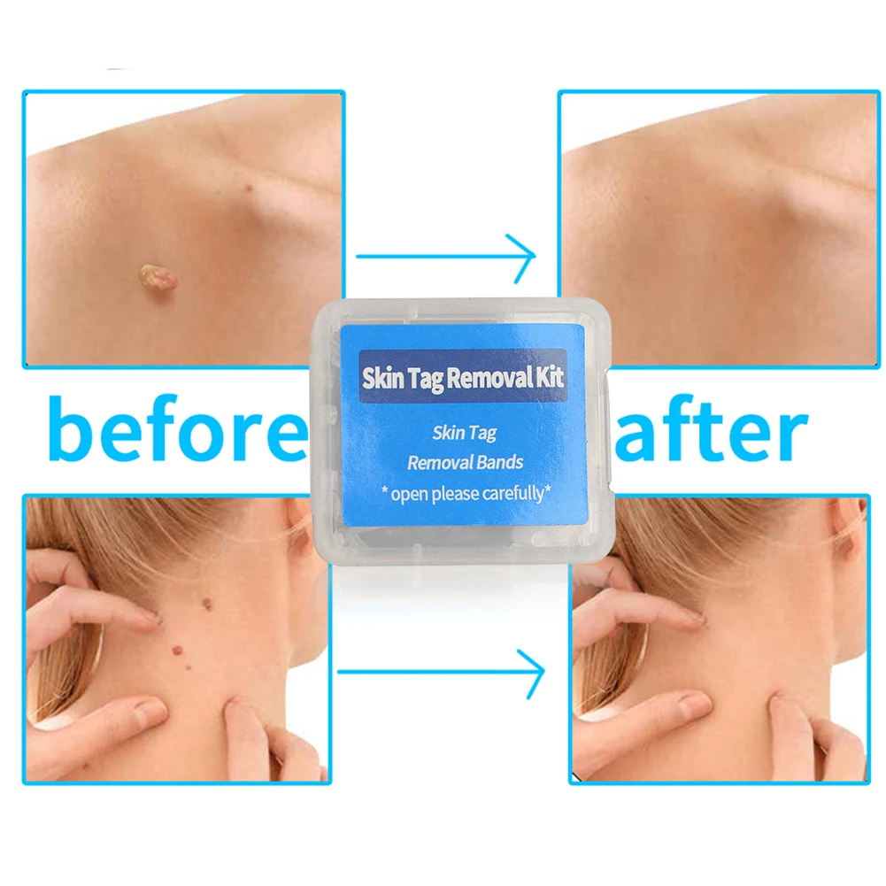 Warts Acne Pimple Treatment Kits 2