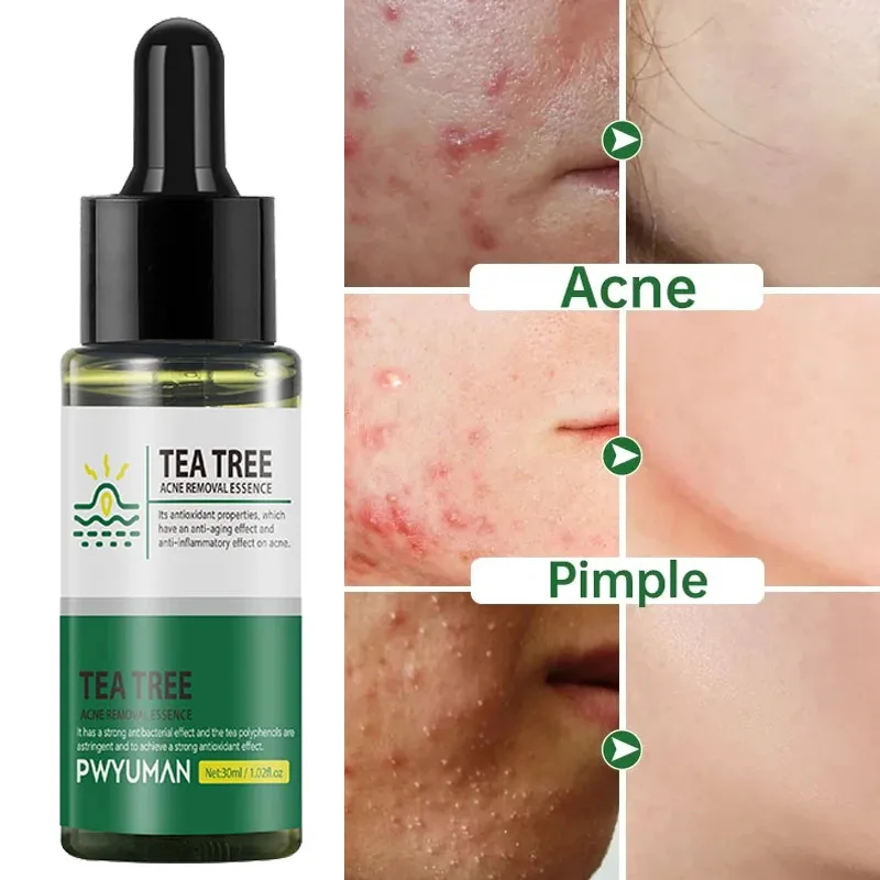 

Tea Tree Serum Acne Treatment Repair Dark Spots Scar Removal Pimples Shrink Pores Anti-Acne Oil Control Moisturizing Skin Care