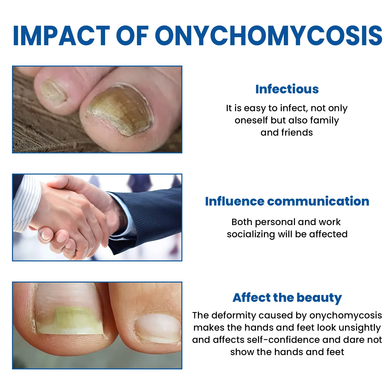 30ML Fungal Nail Treatment Removal Oil Foot Fungus Repair Essence Toe Fungus Removal Gel Anti Infection Best Essenice 발톱무좀