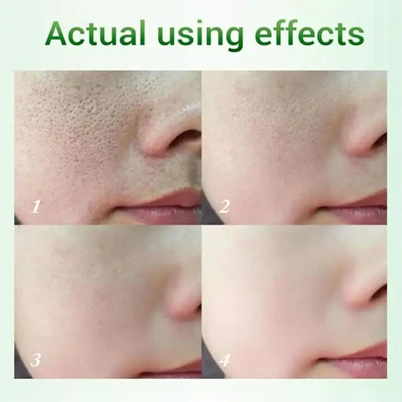 Description Picture 4 of itemSalicylic Acid Pore Shrinking Cream Quick Remove Blackehead Elimination Large Pores Tighten Face Smooth Skin Korean Care Product